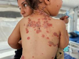 Gaza Children Skin Diseases - Khan Yunis