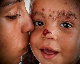 Gaza Children Skin Diseases - Khan Yunis