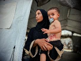 Gaza Children Skin Diseases - Khan Yunis