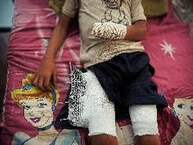 Child Loses Arm in Israel Gaza Conflict