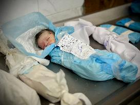 Children Die Amid Malnutrition in Khan Yunis - Palestine