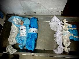 Children Die Amid Malnutrition in Khan Yunis - Palestine