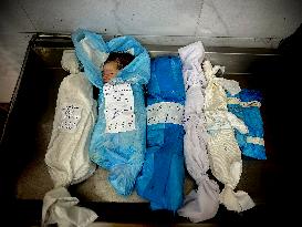 Children Die Amid Malnutrition in Khan Yunis - Palestine