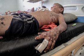 Injured Gaza Children - Palestine